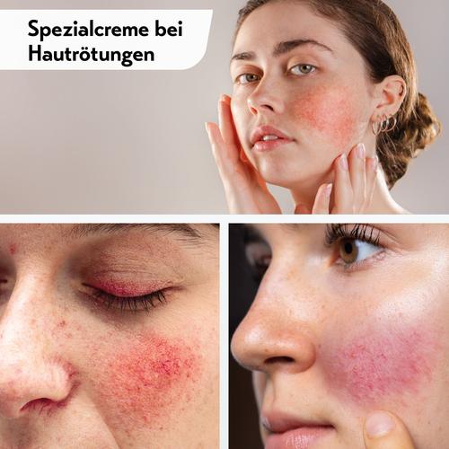 Deruba Creme 2x30 ml Remitan bei onfy.de kaufen 08110791